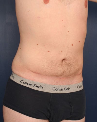 After Image: Tummy Tuck - right-front-oblique