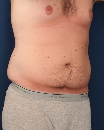 Before Image: Tummy Tuck - right-front-oblique