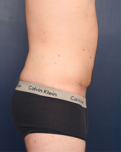 After Image: Tummy Tuck - right-side