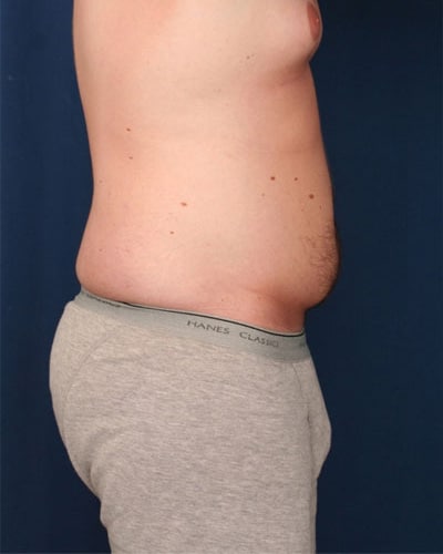 Before Image: Tummy Tuck - right-side