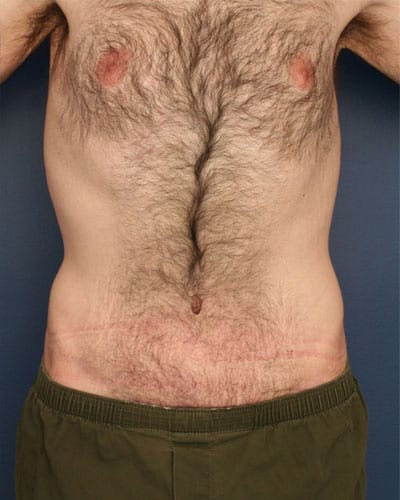 After Image: Tummy Tuck - front