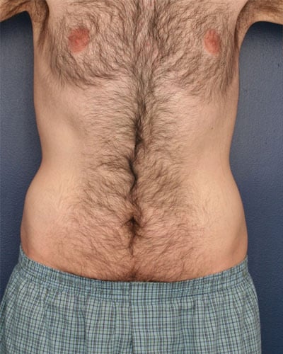 Before Image: Tummy Tuck - front