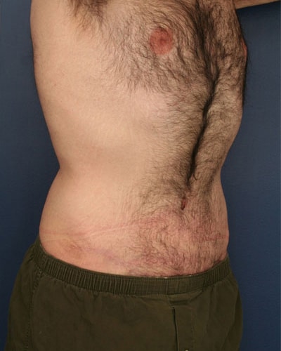 After Image: Tummy Tuck - right-front-oblique
