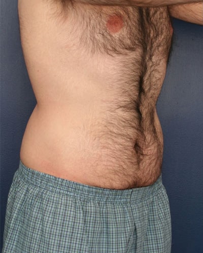 Before Image: Tummy Tuck - right-front-oblique