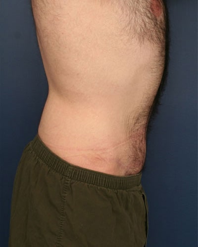 After Image: Tummy Tuck - right-side
