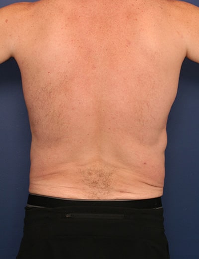 Before Image: Tummy Tuck - back