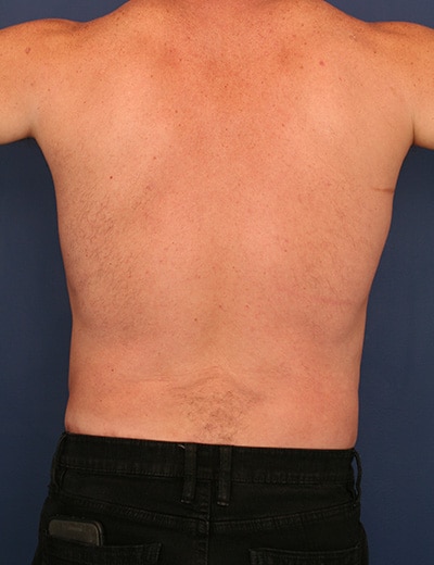 After Image: Tummy Tuck - back