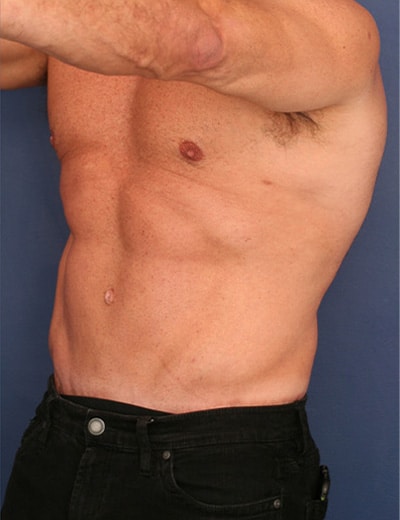 After Image: Tummy Tuck - left-front-oblique