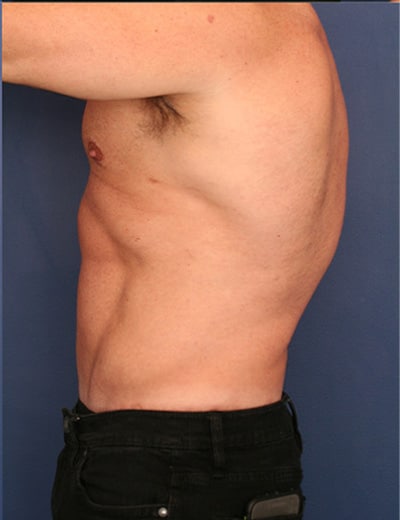 After Image: Tummy Tuck - left-side