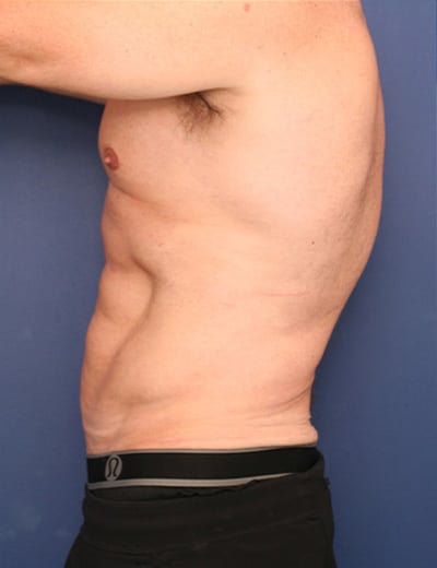 Before Image: Tummy Tuck - left-side