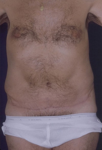 After Image: Tummy Tuck - front