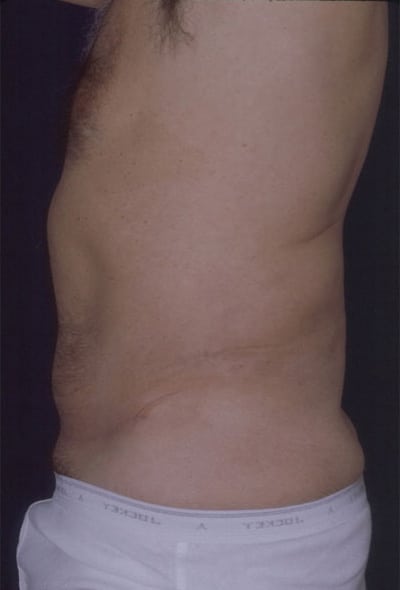 After Image: Tummy Tuck - left-side