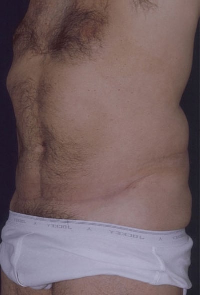 After Image: Tummy Tuck - left-front-oblique