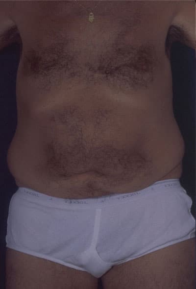 Before Image: Tummy Tuck - front