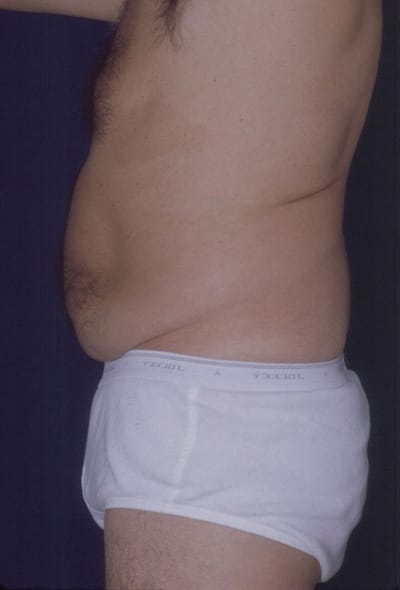Before Image: Tummy Tuck - left-side