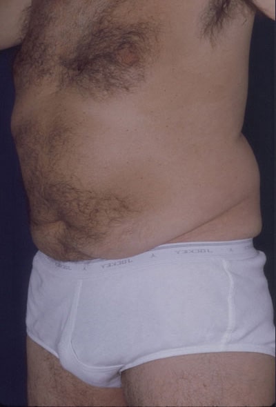 Before Image: Tummy Tuck - left-front-oblique