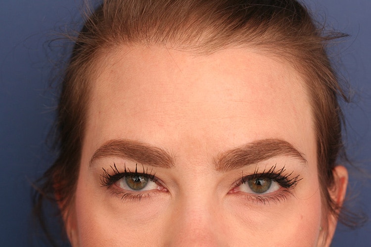 After Image: Vollure to Forehead - front