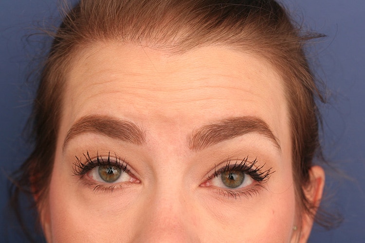 After Image: Vollure to Forehead - front