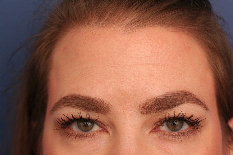 Before Image: Vollure to Forehead - front