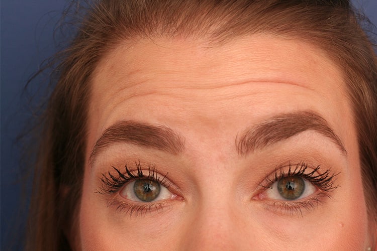 Before Image: Vollure to Forehead - front