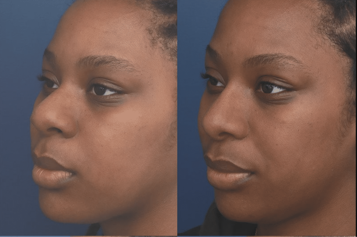 african american rhinoplasty