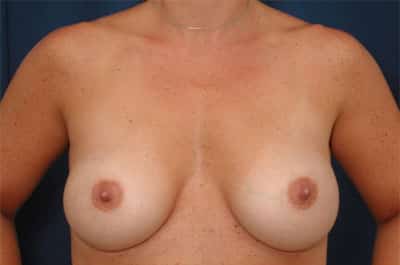 After Image: Breast Augmentation - front