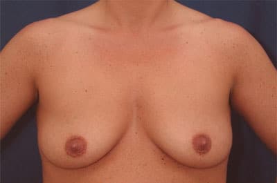 Before Image: Breast Augmentation - front