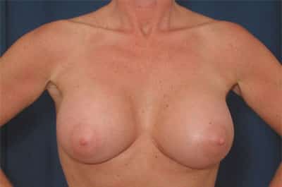 After Image: Breast Augmentation - front