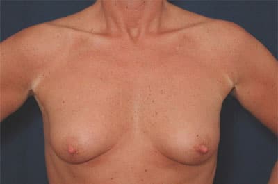 Before Image: Breast Augmentation - front