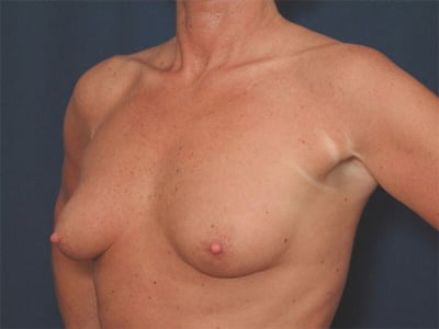Before Image: Breast Augmentation - left-front-oblique