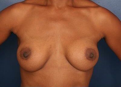 After Image: Breast Augmentation - front