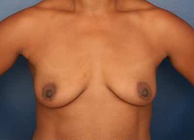 Before Image: Breast Augmentation - front