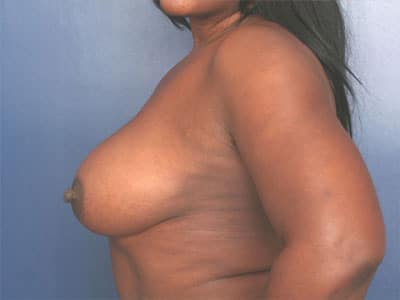 After Image: Breast Augmentation - left-side