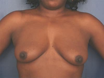 Before Image: Breast Augmentation - front