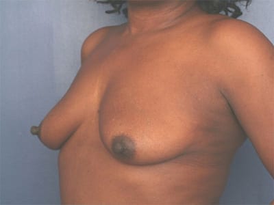 Before Image: Breast Augmentation - left-front-oblique