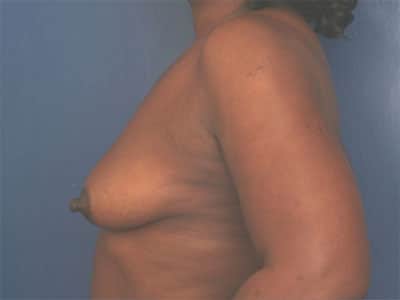 Before Image: Breast Augmentation - left-side