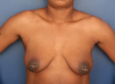 Before Image: Breast Augmentation - front