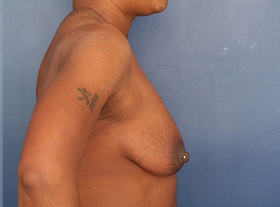 Before Image: Breast Augmentation - right-side