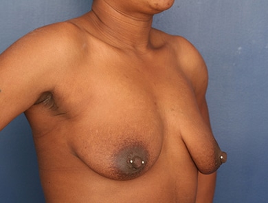Before Image: Breast Augmentation - right-front-oblique