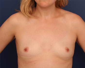 Before Image: Breast Augmentation - front