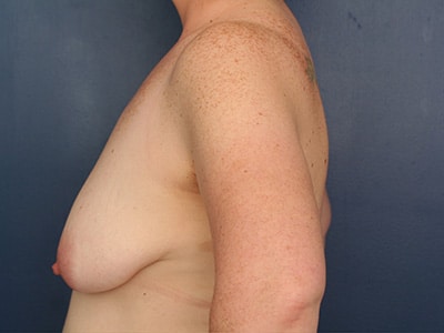Before Image: Breast Augmentation with Lift - left-side