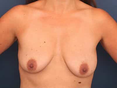 Before Image: Breast Augmentation with Lift - front