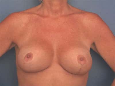 After Image: Breast Augmentation with Lift - front