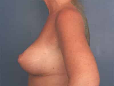 After Image: Breast Augmentation with Lift - left-side