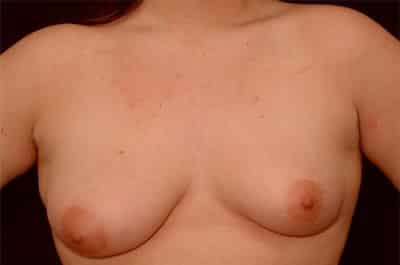 Before Image: Breast Augmentation with Lift - front