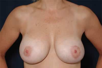 After Image: Breast Augmentation with Lift - front