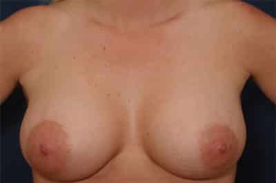 After Image: Breast Augmentation with Lift - front
