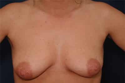 Before Image: Breast Augmentation with Lift - front
