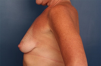 Before Image: Breast Augmentation with Lift - left-side