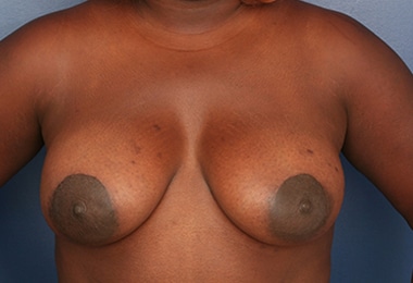 After Image: Breast Augmentation with Lift - front